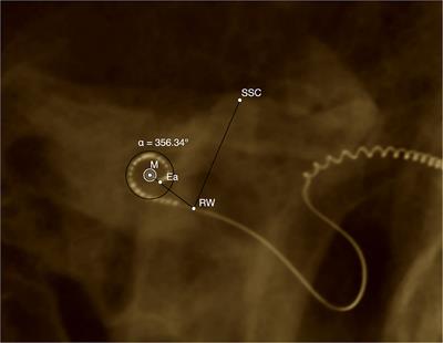 Vertigo Associated With Cochlear Implant Surgery: Correlation With Vertigo Diagnostic Result, Electrode Carrier, and Insertion Angle